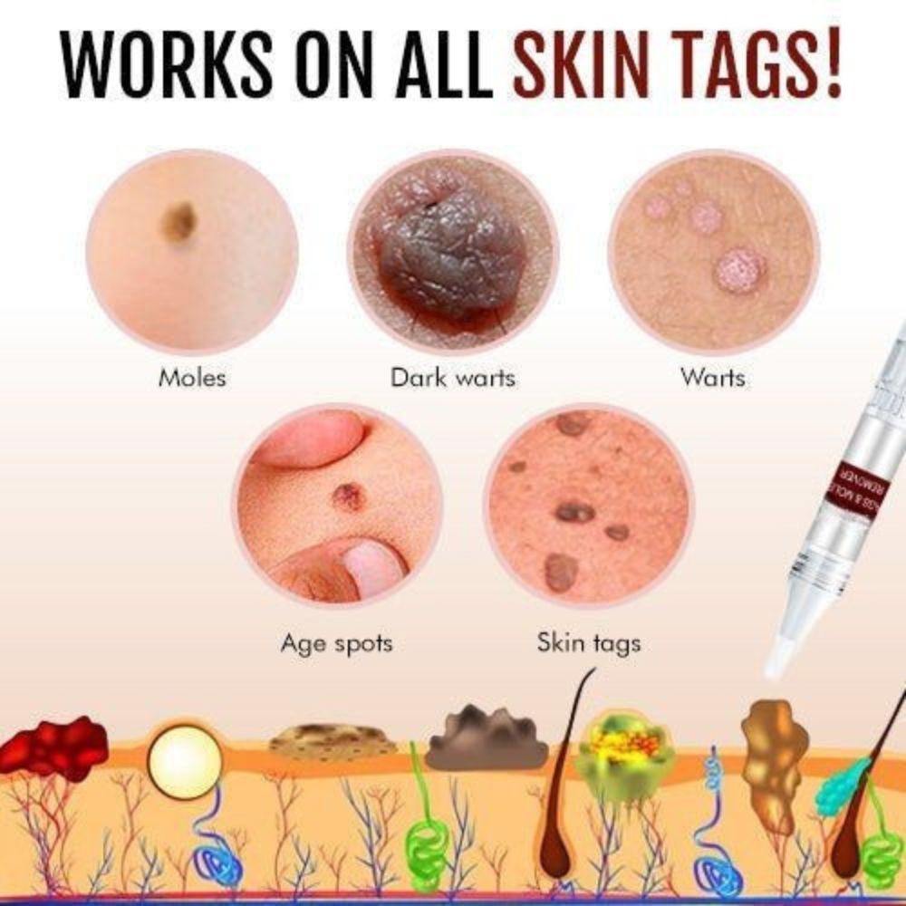 Skin Tag Mole Remover Pen With Tea Tree Oil Fast Home
