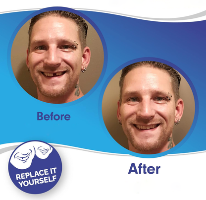 Smile Veneers Upper And Lower Instant Cover For All Day