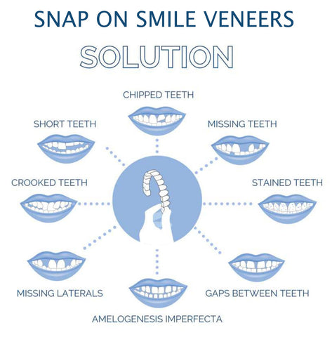 Smile Veneers Upper And Lower Instant Cover For All Day
